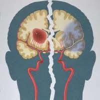 Риск инсульта у мужчин может возрасти после сорока